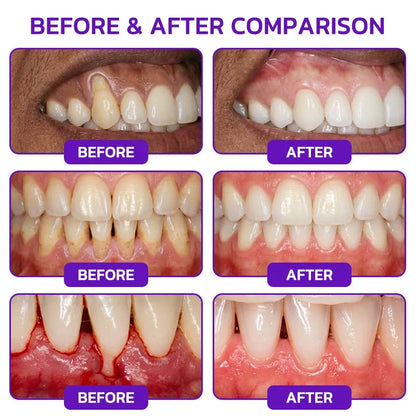 🦷Whimsyandjoy Bee Venom Gingivitis & Periodontitis Treatment Toothpaste