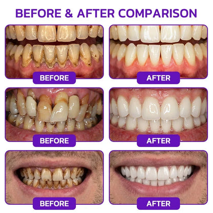 🦷Whimsyandjoy Bee Venom Gingivitis & Periodontitis Treatment Toothpaste