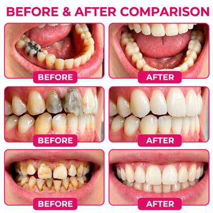 AQA® 🏆DenPerm Cavity-Repair Natural Enamel Filling Gel