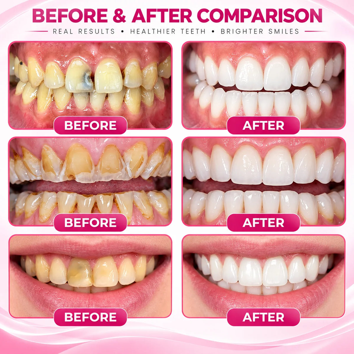 AQA® 🏆DenPerm Cavity-Repair Natural Enamel Filling Gel