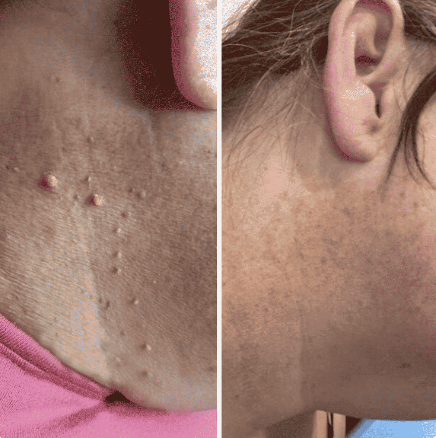 🏆Flash Sale⚡ 50K+ SOLD! Painless Skin Tag Removal Kit