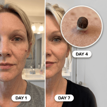 🏆Flash Sale⚡ 50K+ SOLD! Painless Skin Tag Removal Kit